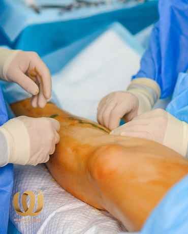 علاج-انسداد-الأوعية-الدموية-في-القدم علاج انسداد الأوعية الدموية في القدم
