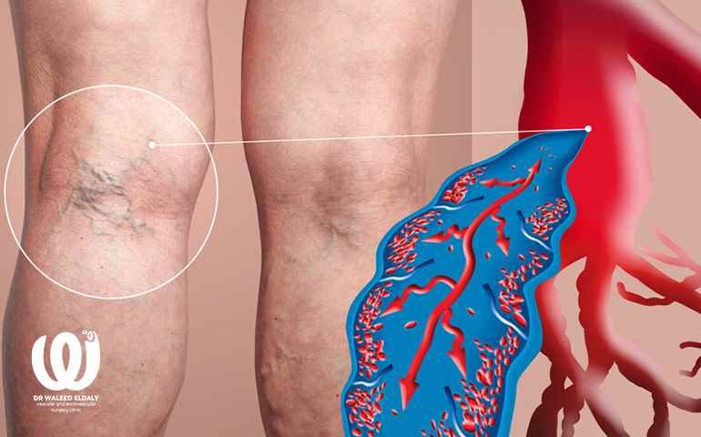 varicose-veins-treatment-with-clax-technique علاج الدوالى بتقنية الكلاكس