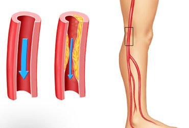 أعراض تصلب شرايين الساق