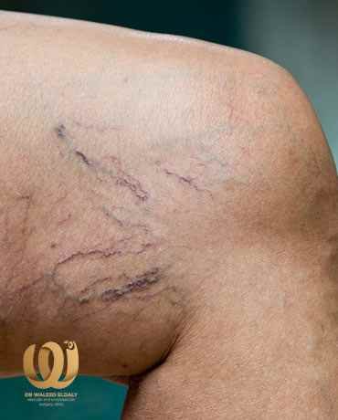 اسباب ظهور الدوالي اسباب ظهور الدوالي