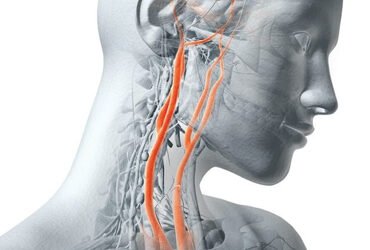 السكتة الدماغية وعلاقتها بانسداد الشريان السباتي