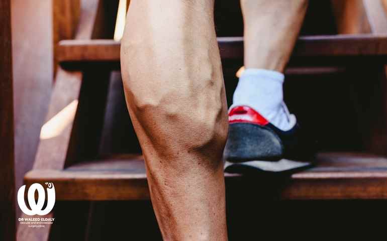 علاج دوالي الساقين بدون جراحة