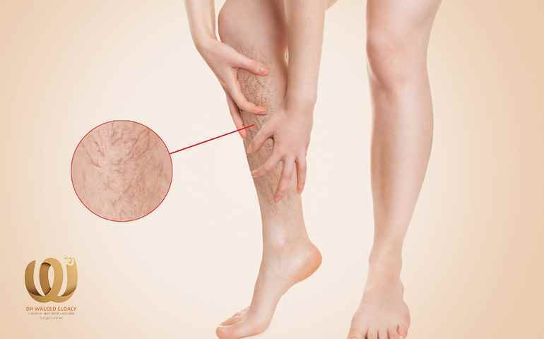 علاج-دوالي-الساقين علاج دوالي الساقين