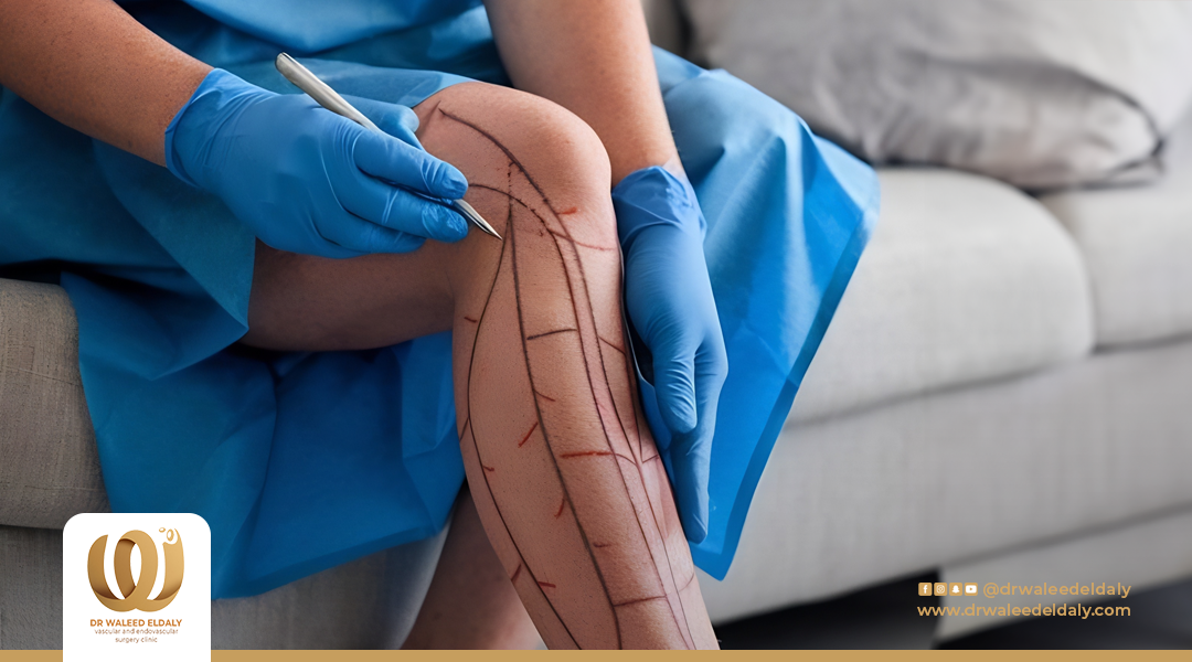 كم مدة الراحة بعد عملية دوالي الساقين؟ وماذا يحدث خلال الأسابيع الأولى؟