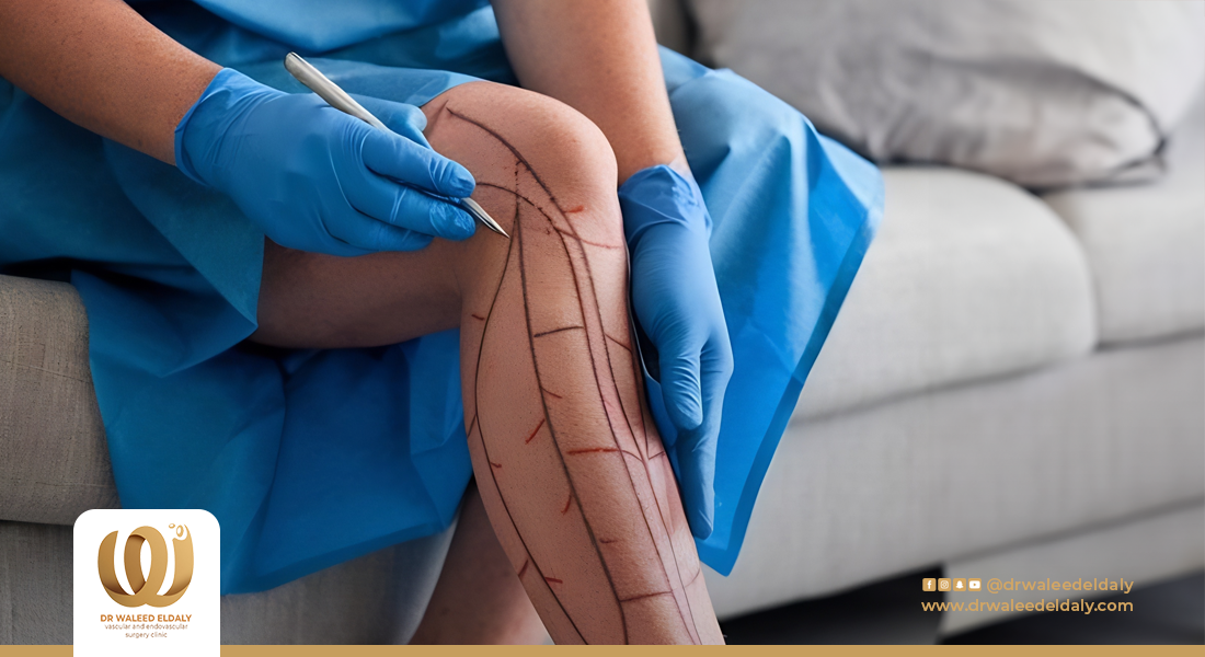 كم مدة الراحة بعد عملية دوالي الساقين