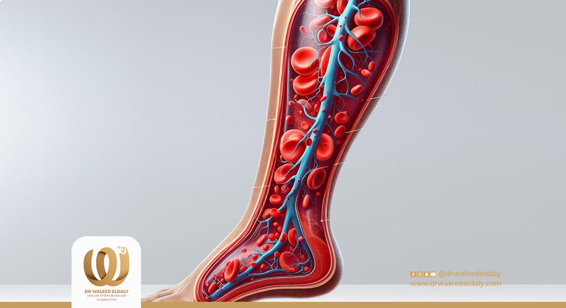 أعراض ضعف الدورة الدموية في الساقين